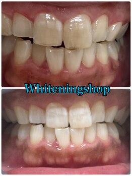 ホワイトニングショップ 山形店(Whiteningshop)/忙しい方でも