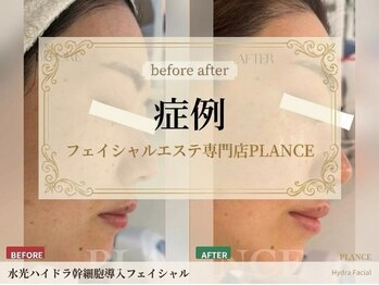 プランス 恵比寿店(PLANCE)/PLANCE症例