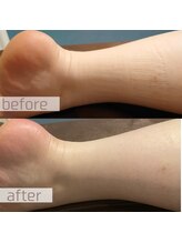 テミシア(TEMISIA)/つらい浮腫に