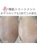 【40代～の肌質改善】ハーブピーリング×ヘッドスパ