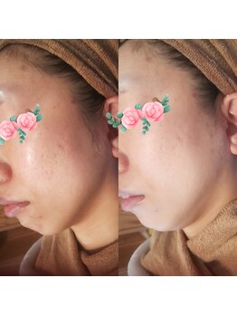 そら/毛穴/ピーリング