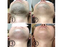 ソレラ(sorelle)/脱毛風景