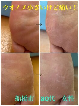 巻き爪じゅん 船橋店/ウオノメ小さいけど痛い！