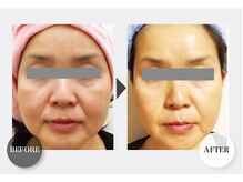 ワンバイゼロ(One by zero)/ハーブピーリング