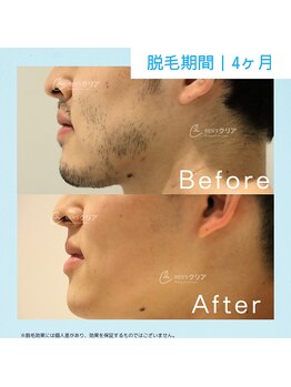 メンズクリア 武蔵小杉店/【メンズクリア】お客様の施術例