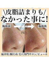 ピュール 鯖江店(PUR)/毛穴サロン/毛穴ケア/毛穴洗浄
