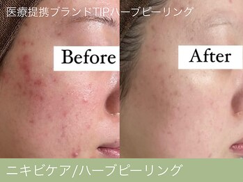 オーエン 小倉店(o-eN)/ニキビケア/ハーブピーリング