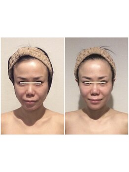 小顔になりたい