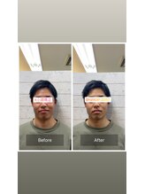カラダプラス(kArAdA+)/小顔矯正ビフォーアフター男性