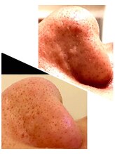 カランコエ(KALANCHOE)/目立つ角栓にも！毛穴ケア！