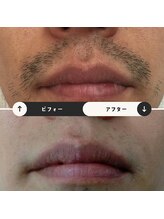 ジュゴン(Dugong)/ひげ脱毛（Before＆After）