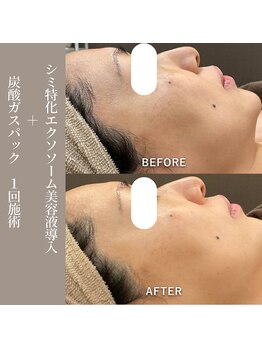 コンバートビューティーオタイ(ConBert Beauty otai)/新シミ改善美容液導入