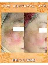 ナイア(naia)/リセラADS使用症例