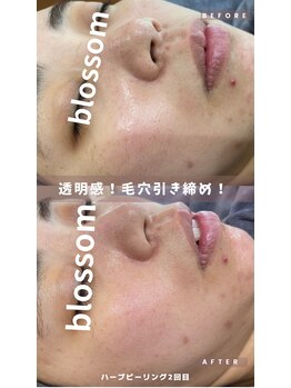 ブロッサム(Blossom)/ハーブピーリング1回目