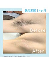 メンズクリア 武蔵小杉店/【メンズクリア】お客様の施術例