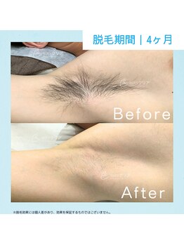 メンズクリア 武蔵小杉店/【メンズクリア】お客様の施術例