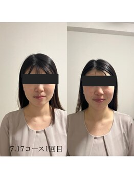 マハロ 海老名店(Mahalo)/小顔矯正　20代女性