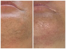 フェリス(FELIZ)/鹿児島ヒゲ脱毛はここ！