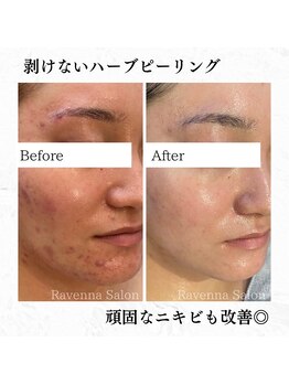 ラヴェンナサロン 札幌店(Ravenna salon)/REVIハーブピーリング♪