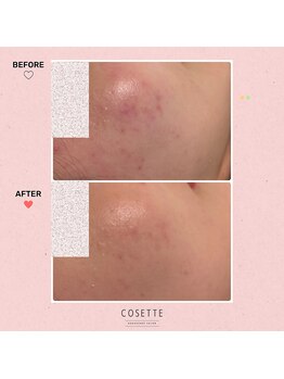 コゼット(Cosette)/トラブル後の赤みの改善
