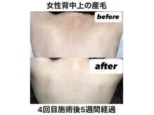 ルリアン(Le Lien)/【レディース】背中症例