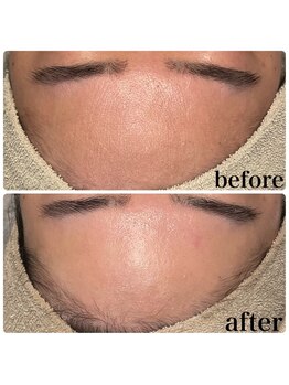 ディオーネ 春日井勝川店(Dione)/顔脱毛+毛穴洗浄