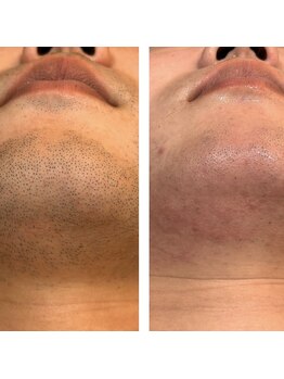 ハグ(hug)/ひげ脱毛