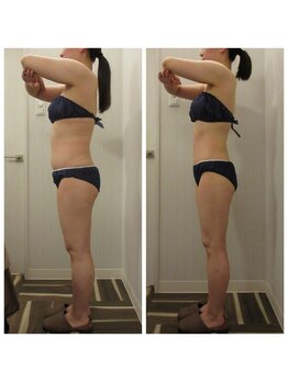 痩身脱毛専門店 グレイスボディ MEGAドンキホーテ三郷店(Gracebody)/◆痩身　症例写真