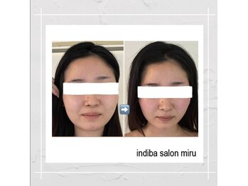 ミル(miru)/両頬吸引術後インディバケア