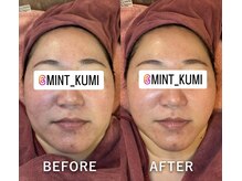 ミント(Mint)の雰囲気(【人気の小顔リフト】劇的ビフォアフ!施術30分で速攻小顔◎)