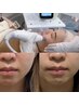 【20代～小顔ケア】エステ版ポテンツァでスッキリ引き締め＆リフトアップ!