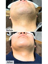 ラフ(LaFF)/首脱毛Before＆After