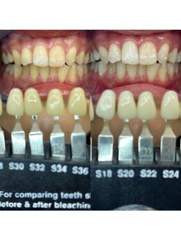 トウキョウスワーズ 池袋店(TOKYO SWRS)/#ホワイトニング #池袋 #渋谷