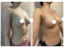 ハイファイブ(Hi-Five)/バストアップ/施術10回目