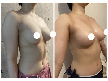 ハイファイブ(Hi-Five)/バストアップ/施術10回目