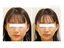 メディカルエステ 大宮店/＊高周波症例写真＊