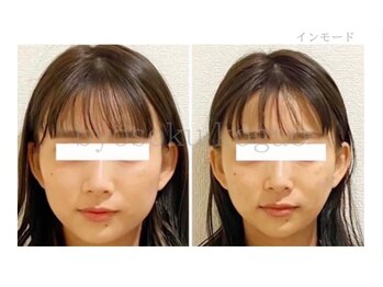 メディカルエステ 大宮店/＊高周波症例写真＊