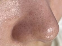 フェイシャル/脱毛/マッサージ/ドライヘッドスパ/毛穴/三軒茶屋