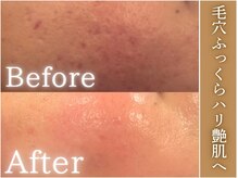 １度の施術でここまで激変！なめらかでふっくらしたハリ艶肌に◎
