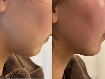 ゼニス 池袋本店(ZENITH)/レモンボトル超のレッドショット