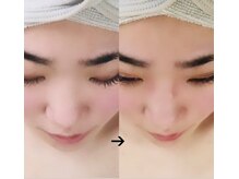 美助(bisuke)/高鼻矯正・美鼻施術のお写真