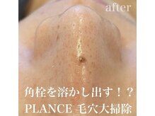 プランス 福岡本店(PLANCE)/毛穴大掃除