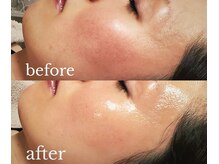 カサブランカ(CASABLANCA)/UNSTRESS症例