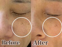 いやしの家さくら/シミケア打ち放題ビフォーアフタ