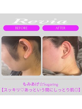 レビア(Revia)/もみあげ＆うなじ/before→after
