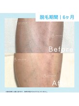 メンズクリア 武蔵小杉店/【メンズクリア】お客様の施術例