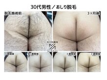 メンズアメリ/高知/メンズ脱毛/ヒゲ/全身/VIO