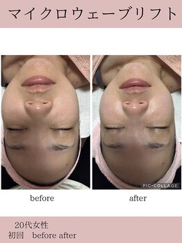 サロンドココ(Salon de COCO)/マイクロウェーブリフト