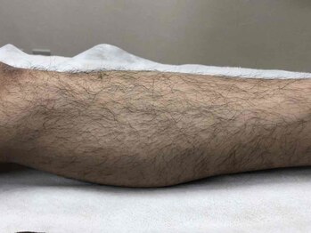 エルミューノ(elμno)/脚脱毛 ビフォー