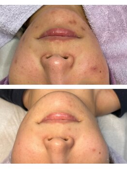 ディンプル(Dimple)/顔脱毛　フェイシャル　毛穴